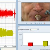 Electromyogram examining muscle activity in an habitually tremulous muscle during performance.